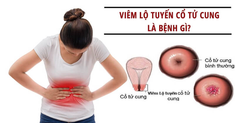 Viêm lộ tuyến cổ tử cung là bệnh lý phụ khoa rất thường gặp ở độ tuổi sinh đẻ