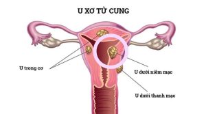 Cách điều trị rong kinh do u xơ dưới niêm mạc