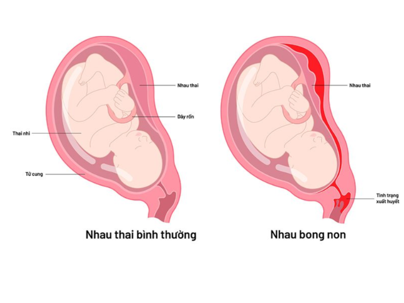 Bong nhau thai gây thai lưu