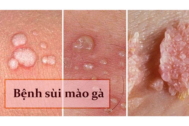 Chưa quan hệ nhưng bị sùi mào gà