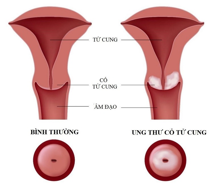 Hình ảnh minh họa ung thư cổ tử cung.