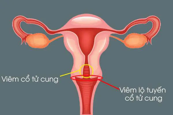 Giải đáp: Viêm lộ tuyến cổ tử cung 2cm nặng hay nhẹ?