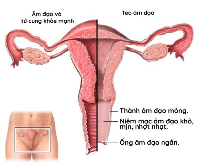 Teo âm đạo gây ngứa 2 bên mép vùng kín