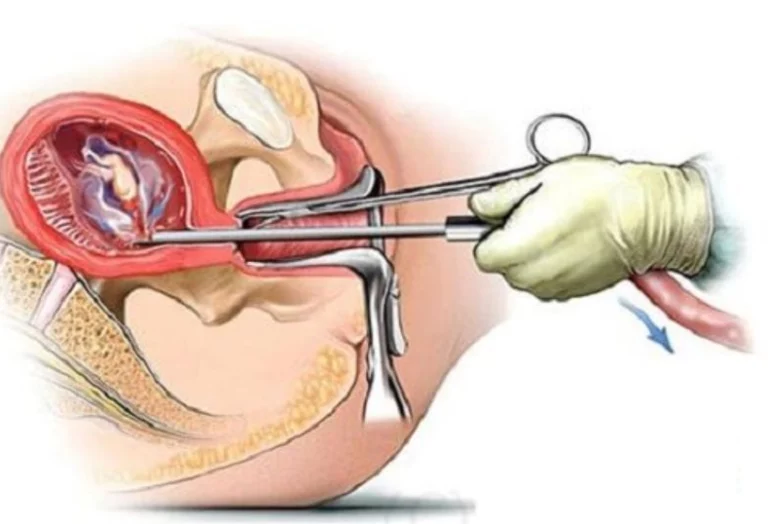  Đốt viêm lộ tuyến có đau không