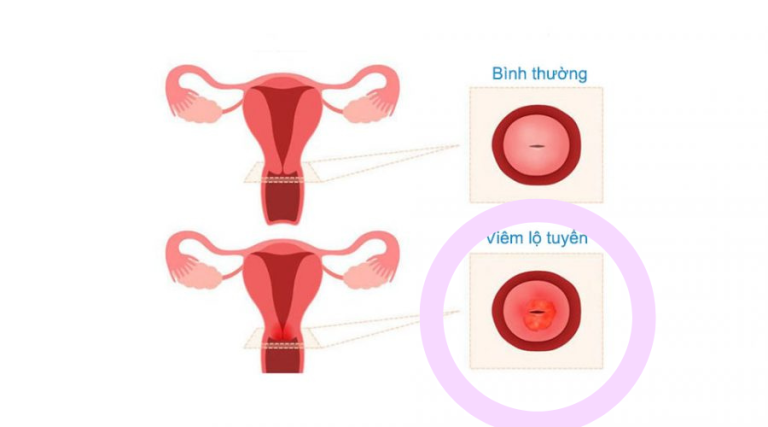 Bị lộ tuyến là gì? Có nguy hiểm không?