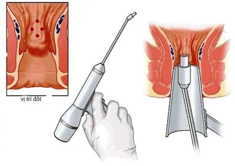 Sau đốt viêm lộ tuyến ra máu bao lâu có thể phụ thuộc vào kỹ thuật thực hiện