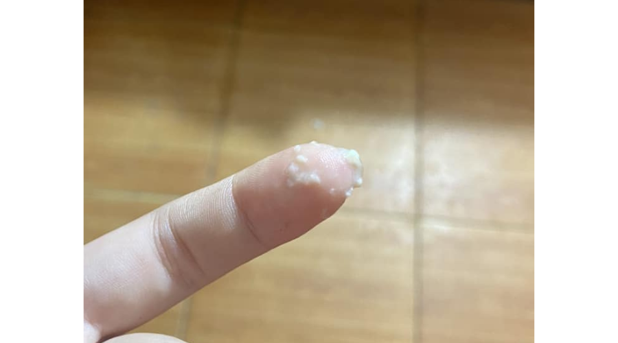 Ra khí hư nâu đen trong kì kinh nguyệt 2 Hình ảnh khách hàng ẩn danh cung cấp