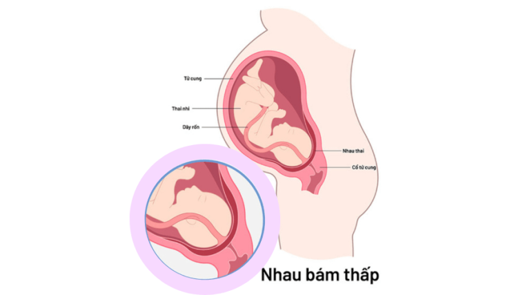 nhau thai bám thấp