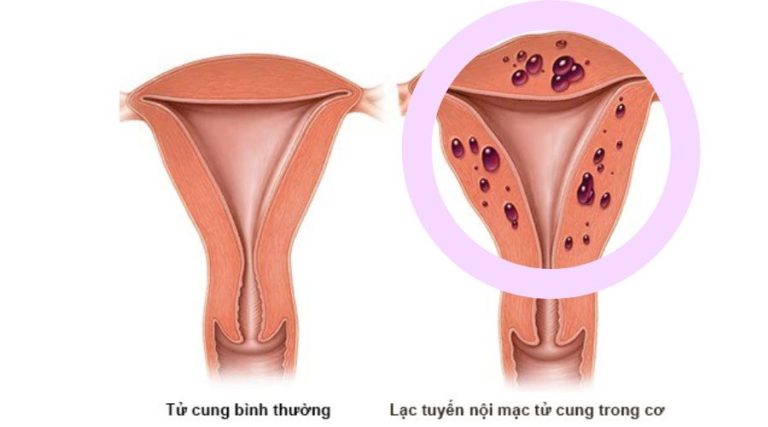 Cách điều trị rong kinh do lạc nội mạc tử cung?