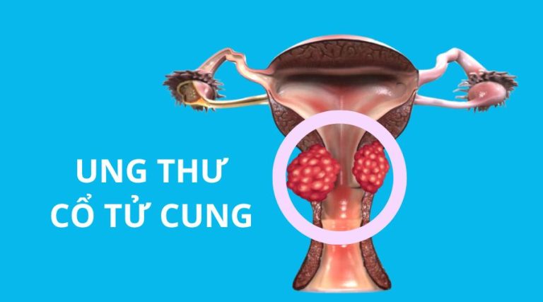 Tầm soát ung thư cổ tử cung