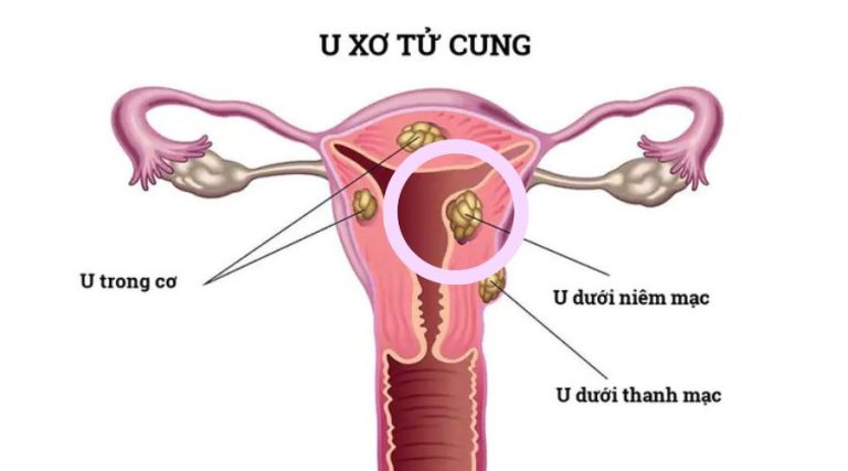 Cách điều trị rong kinh do u xơ dưới niêm mạc