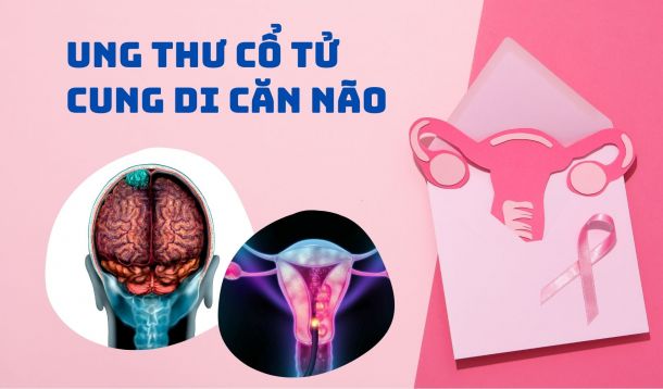 Ung thư cổ tử cung di căn não là giai đoạn cuối của ung thư cổ tử cung