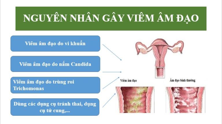 Nguyên nhân gây viêm âm đạo