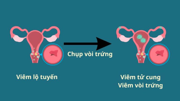 Chụp tử cung vòi trứng khi đang bị viêm lộ tuyến có thể dẫn tới tình trạng viêm nhiễm nặng hơn