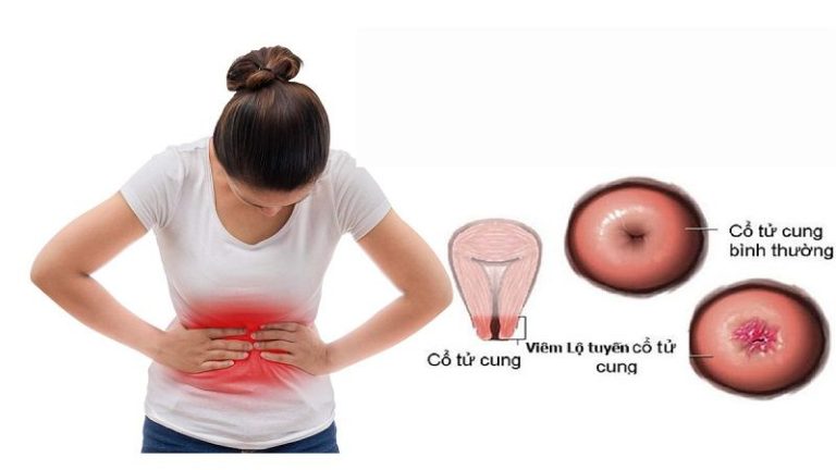 Bị viêm lộ tuyến cổ tử cung có quan hệ được không?