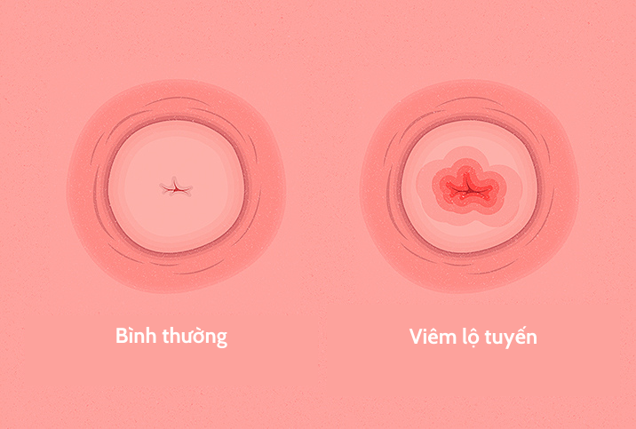 Viêm lộ tuyến cổ tử cung