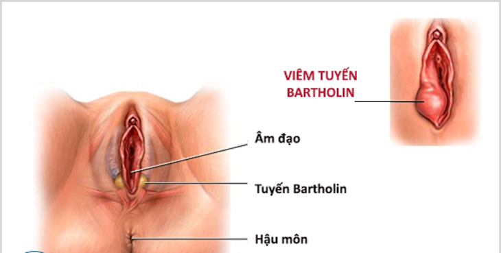 Bi bệnh viêm tuyến bartholin có thể tự khỏi ?