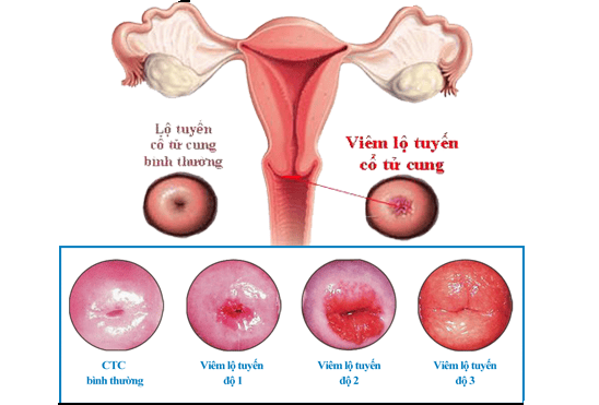 viêm lộ tuyến