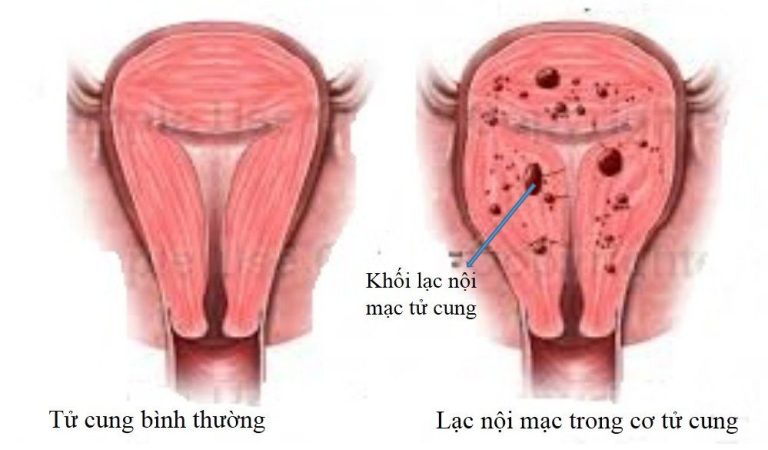 lạc nội mạc tử cung