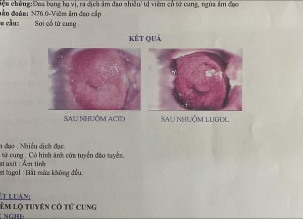 viêm lộ tuyến cổ tử cung