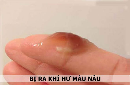 khí hư