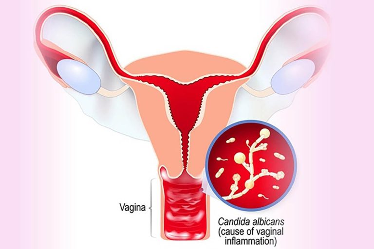 nấm candida