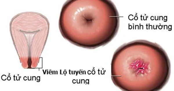 viêm lộ tuyến cổ tử cung