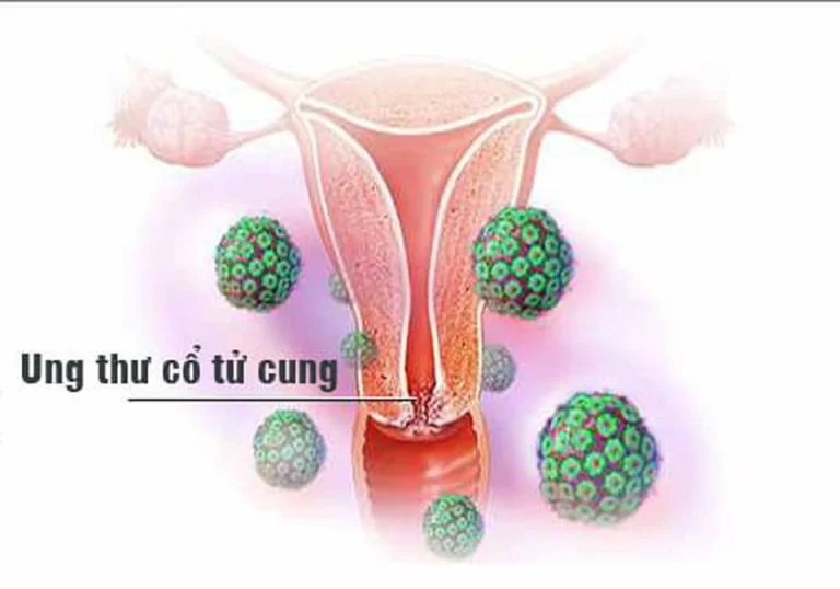 ung thư cổ tử cung