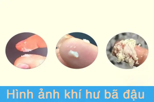 khí hư bã đậu