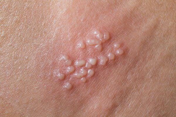 Mụn rộp sinh dục