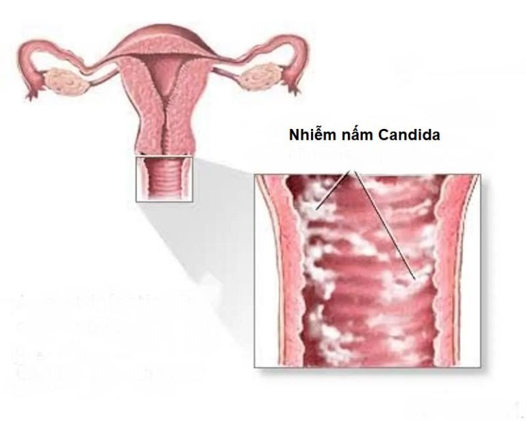 nấm candida