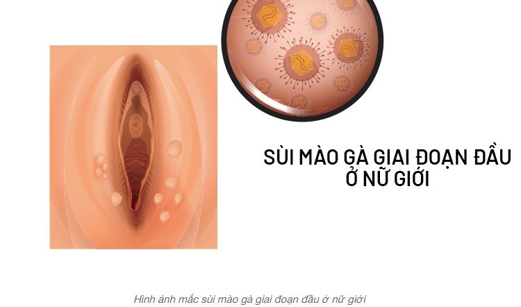sùi mào gà