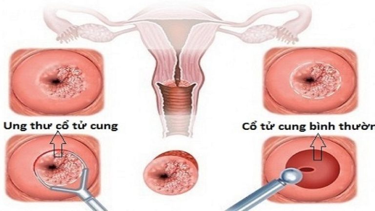 tầm soát ung thư cổ tử cung