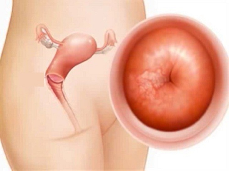 viêm lộ tuyến