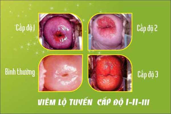 viêm lộ tuyến cổ tử cung