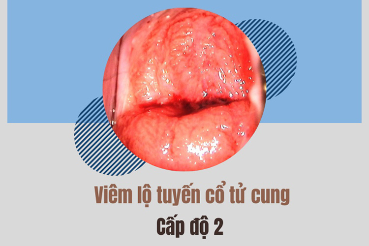viêm lộ tuyến