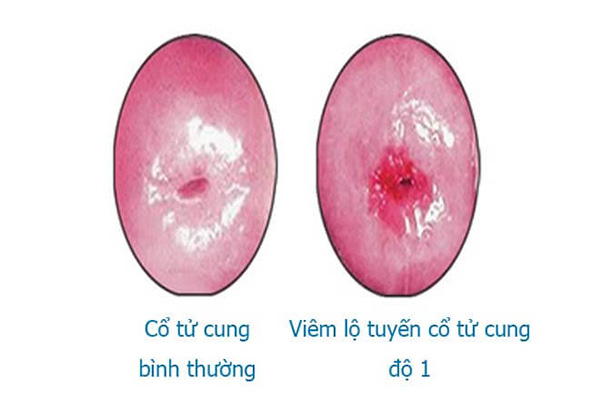 viêm lộ tuyến