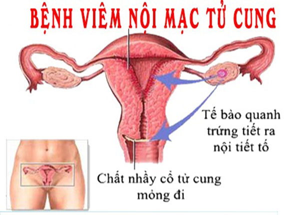tử cung