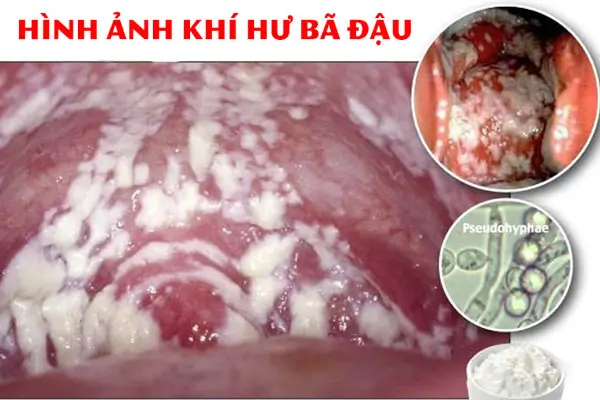 khí hư
