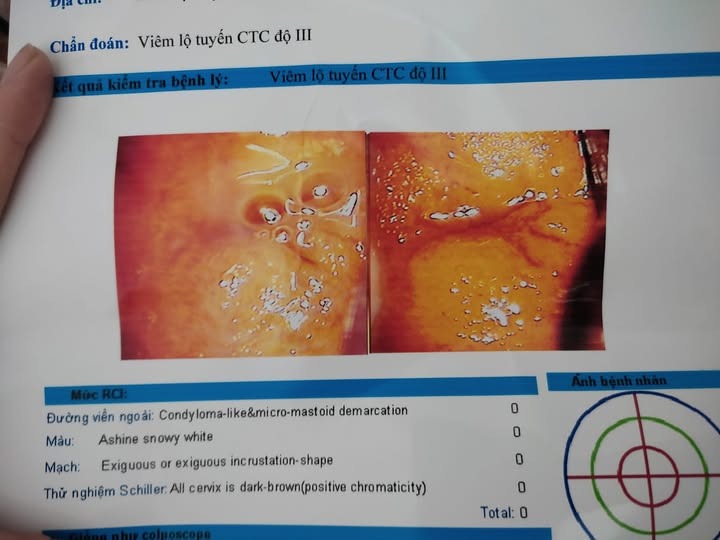 viêm lộ tuyến