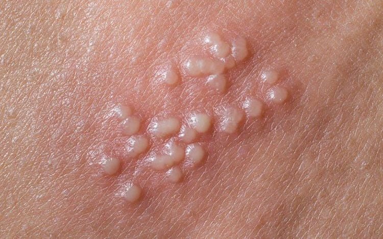 Herpes sinh dục