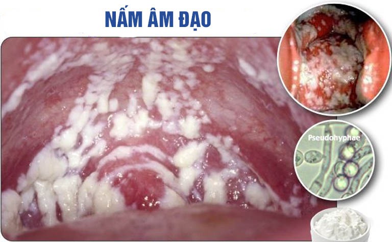viêm nấm âm đạo
