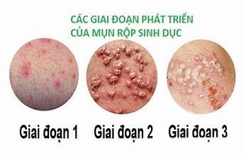 mụn rộp sinh dục