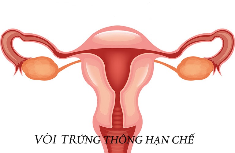vòi trứng