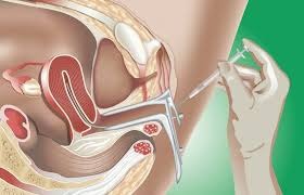 IUI