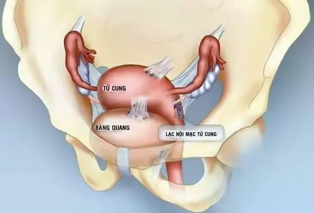 lạc nội mạc tử cung