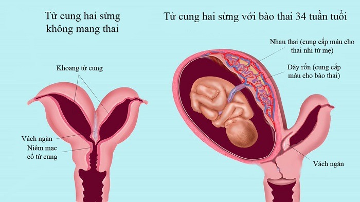 tử cung