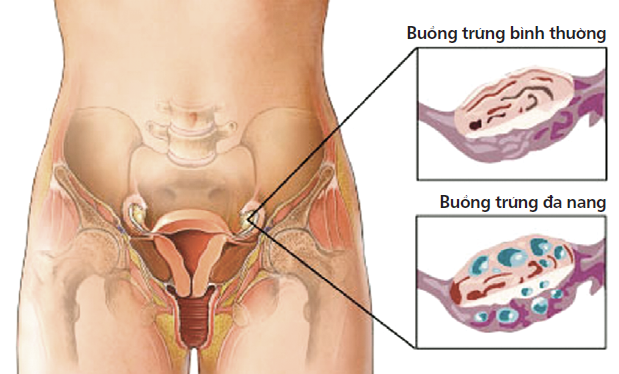 đa nang buồng trứng