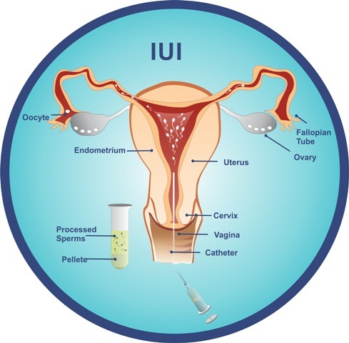 IUI
