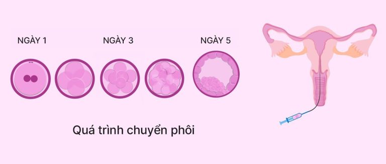 IVF